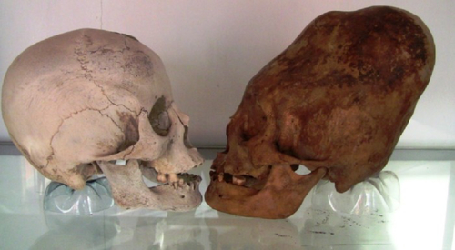 Paracas Culture - Deformed Skulls